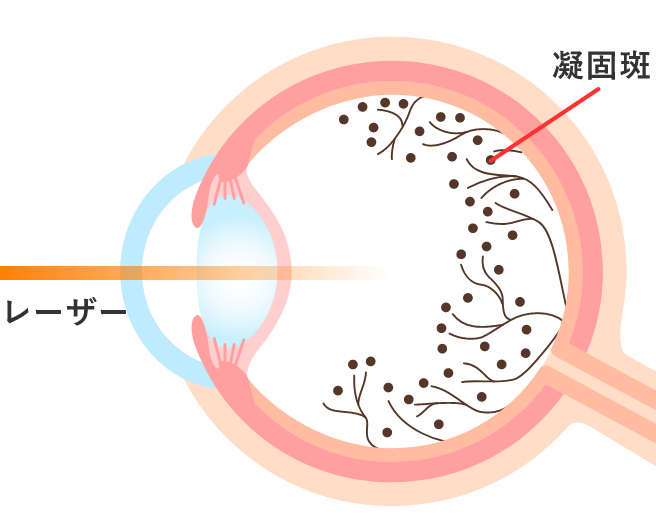 レーザー光凝固術