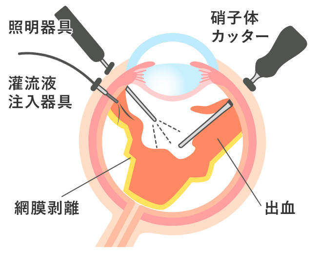 硝子体手術