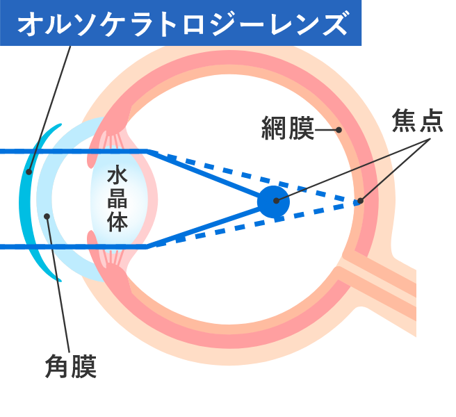 夜:レンズ装用中