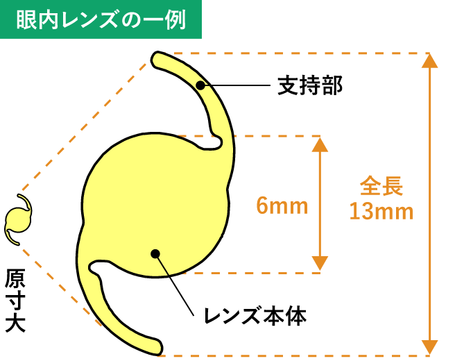 眼内レンズとは?
